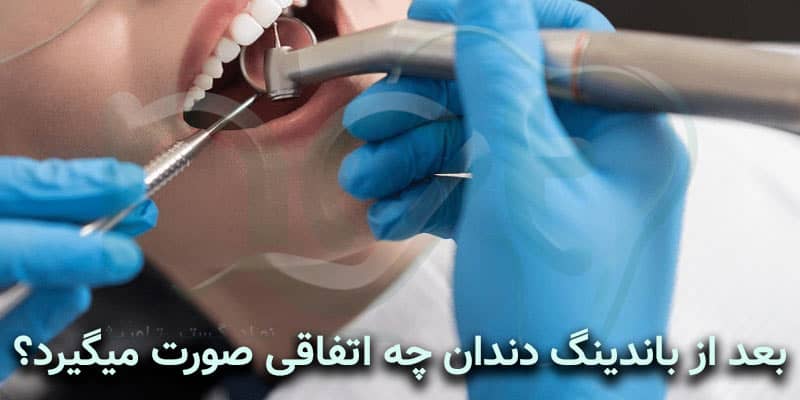 بعد از باندینگ دندان چه اتفاقی صورت میگیرد؟